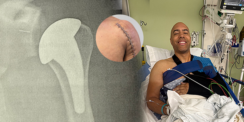 How Transparent Labs Supplements Supported My Shoulder Surgery Recovery